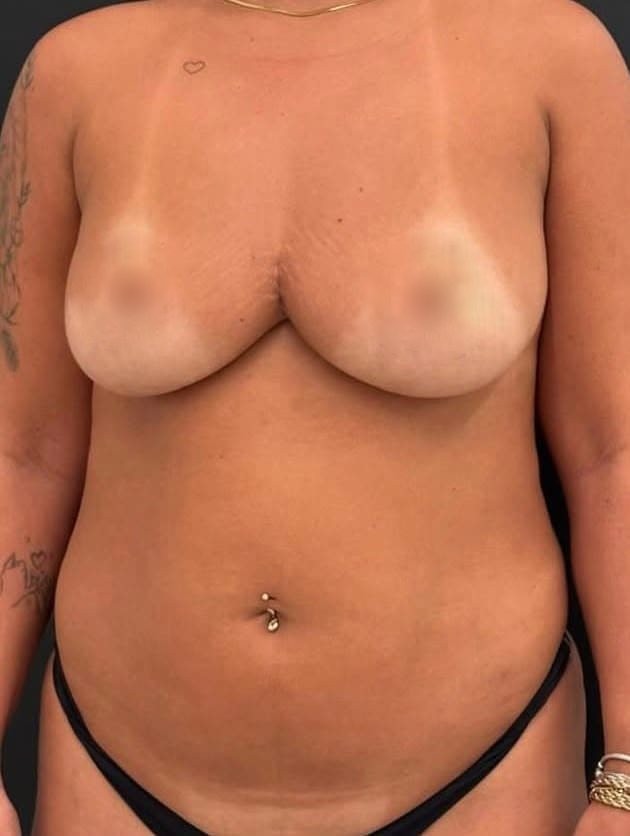 Antes — Abdominoplastia