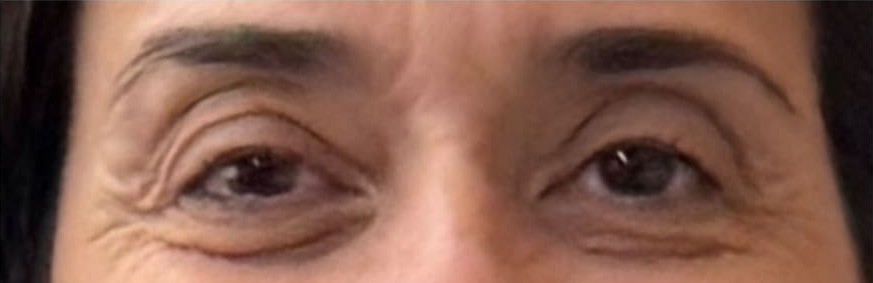 Antes — Blefaroplastia
