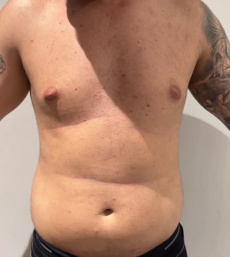 Antes — Lipoaspiração